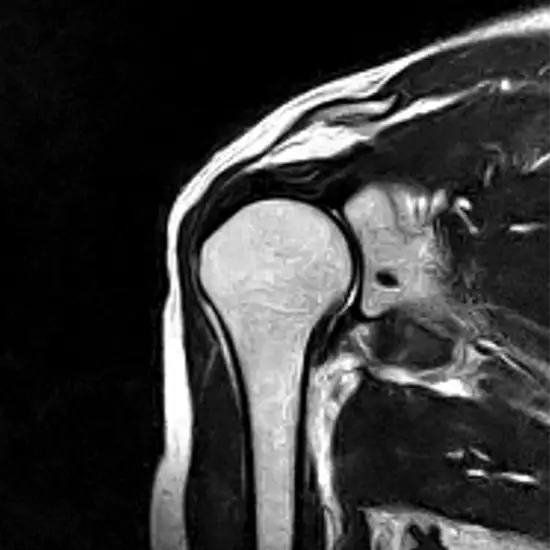 MRI Screening Of Shoulder